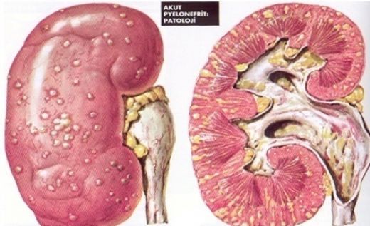 Üremi Hastalığı Belirtileri ve Tedavisi
